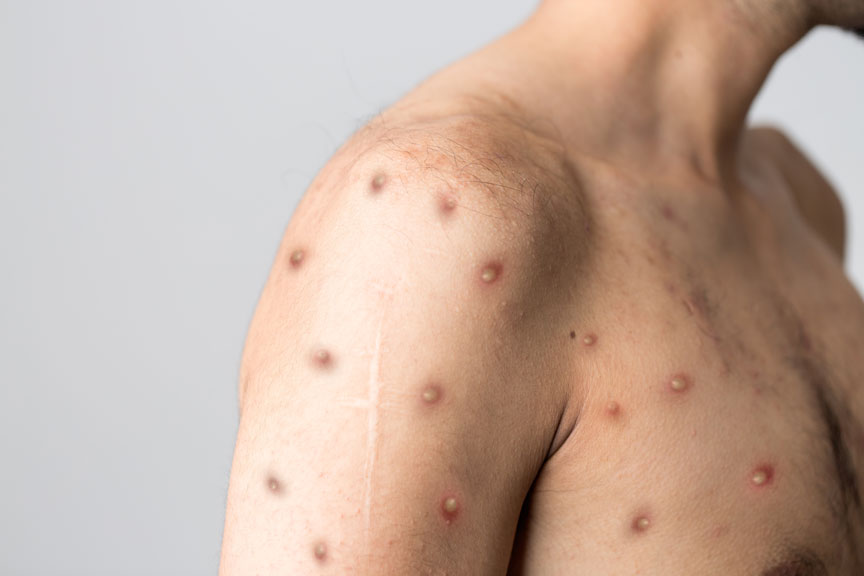 A human torso showing the monkeypox rash symptom